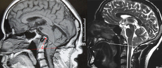 MALFORMAÇÕES DA TRANSIÇÃO CRÂNIO CERVICAL NEUROCIRURGIÃO São Paulo SP