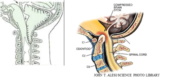 MALFORMAÇÕES DA TRANSIÇÃO CRÂNIO CERVICAL NEUROCIRURGIÃO São Paulo SP