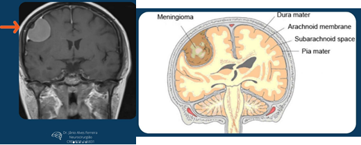 Tumor cerebral NEUROCIRURGIÃO São Paulo SP