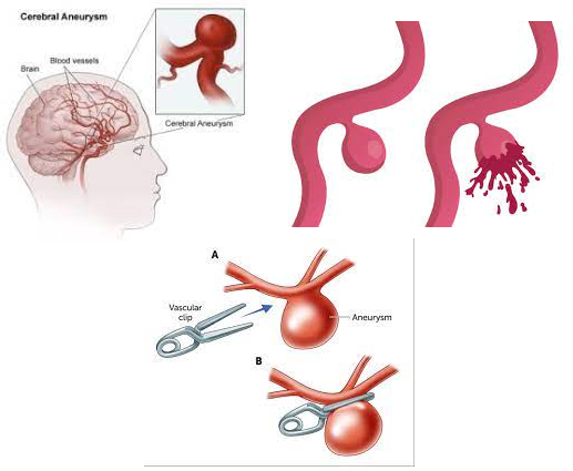 ANEURISMA CEREBRAL NEUROCIRURGIÃO São Paulo SP