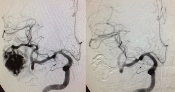 MALFORMAÇÃO ARTERIOVENOSAS CEREBRAIS NEUROCIRURGIÃO São Paulo SP