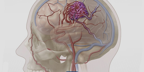 MALFORMAÇÃO ARTERIOVENOSAS CEREBRAIS NEUROCIRURGIÃO São Paulo SP