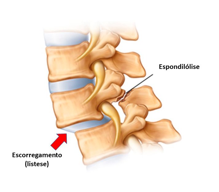 ESPONDILOLISTESE NEUROCIRURGIÃO São Paulo SP