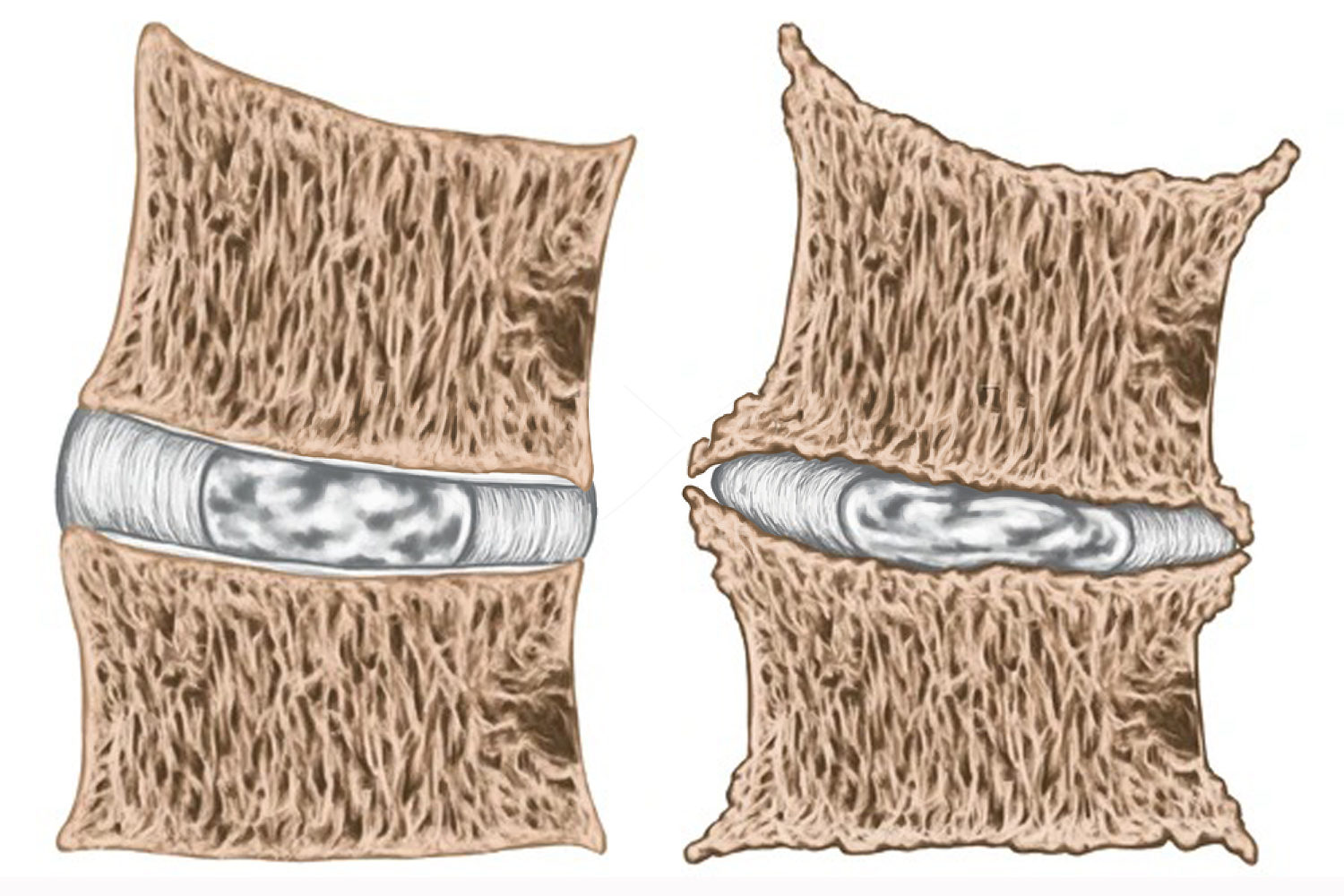 Bico-de-papagaio-neurocirurgia-sao-paulo