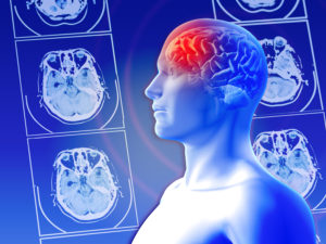 É possível evitar um aneurisma cerebral? Neurocirurgião São Paulo SP