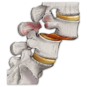 Espondilolistese - Neurocirurgião São Paulo - SP