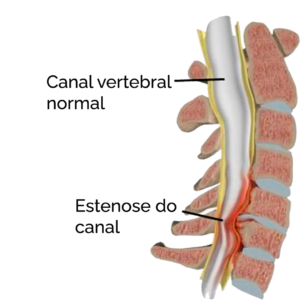 Estenose de canal vertebral - Neurocirurgião - São Paulo - SP