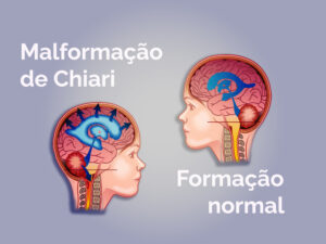 O que você precisa saber sobre a Malformação de Chiari - Neurocirurgião São Paulo - SP