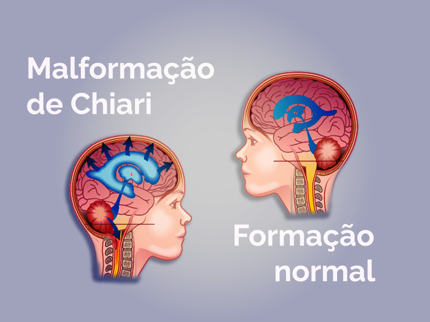 O que você precisa saber sobre a Malformação de Chiari - Neurocirurgião São Paulo - SP