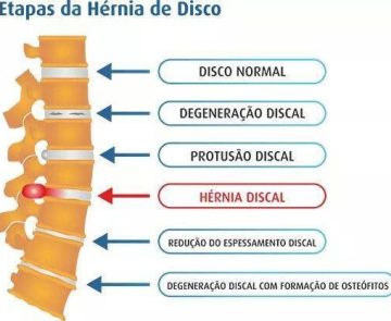 Hérnia de disco Neurocirurgião São Paulo SP